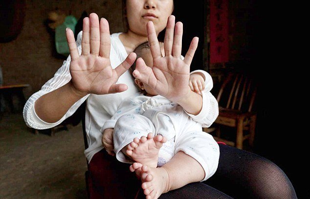 В Китае родился мальчик у которого 31 палец