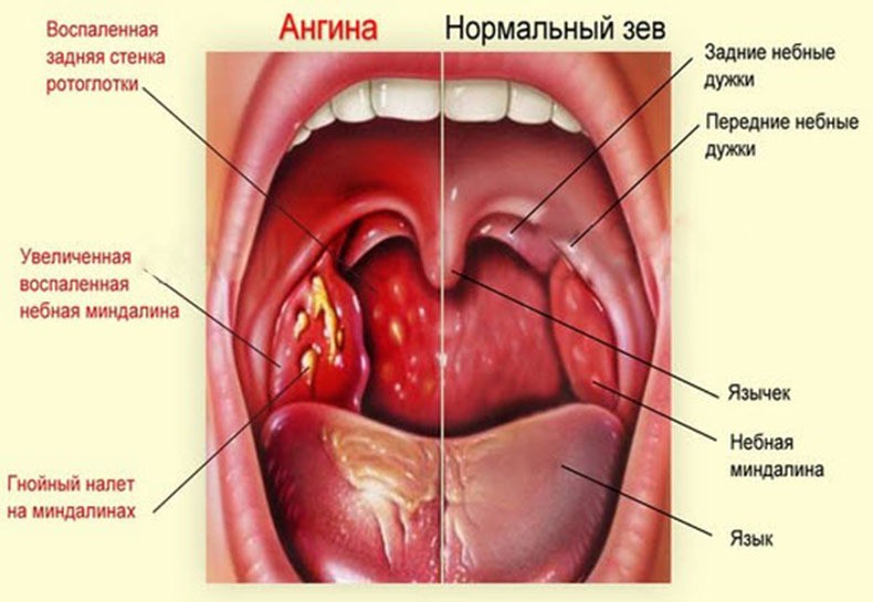 7 природных средств от боли в горле