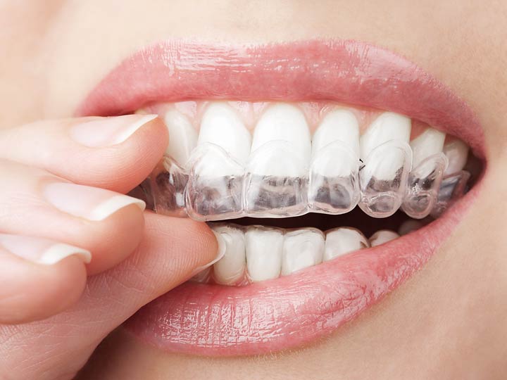 Как отбелить зубы самостоятельно