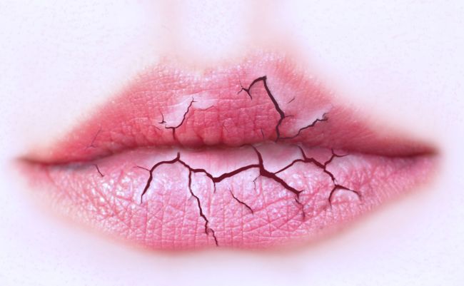 Сохнут губы: как справиться с проблемой сухих губ