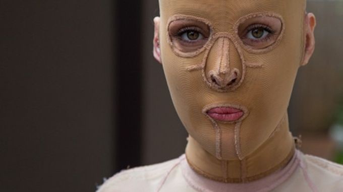 Жизнь без лица закончена: австралийка сняла маску, которую носила 2,5 года