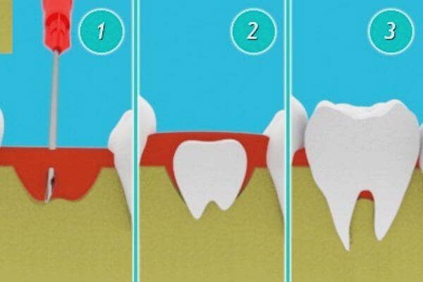 Новейшая технология позволит выращивать собственные зубы всего за 9 недель!