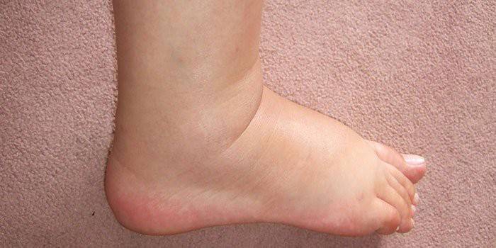 Лечение варикозного расширения вен на ногах в домашних условиях