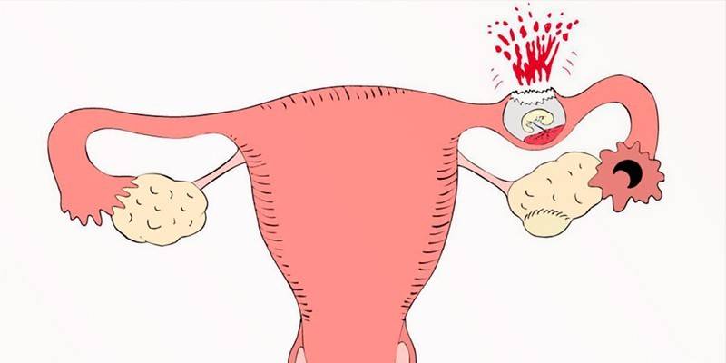 Субмукозная миома матки: признаки и лечение